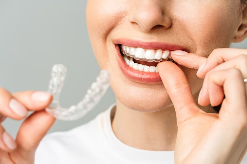 ¿Conoces la ortodoncia invisible y sus grandes prestaciones?