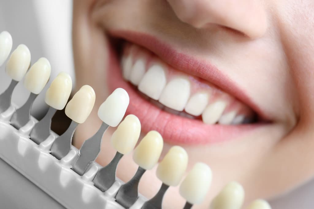 ¡Mejora tu sonrisa con un tratamiento de carillas dentales!